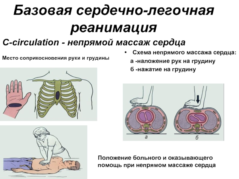 Непрямой массаж сердца схема