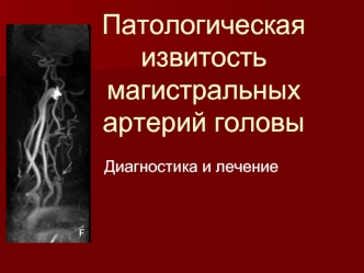 Патологическая извитость магистральных артерий головы