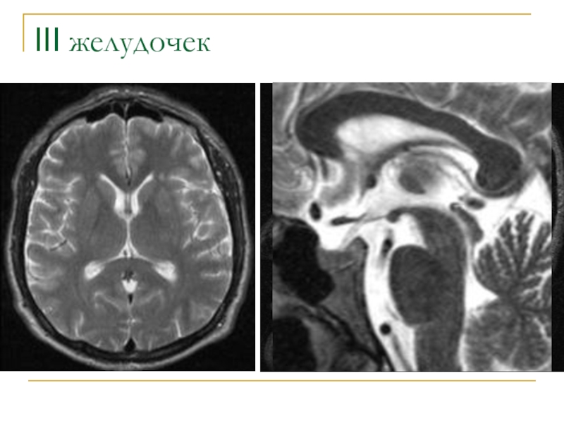 3 желудочек. Желудочки головного мозга кт. 3 Желудочек головного мозга кт. Желудочки головного мозга кт анатомия. 3 Желудочек головного мозга мрт.