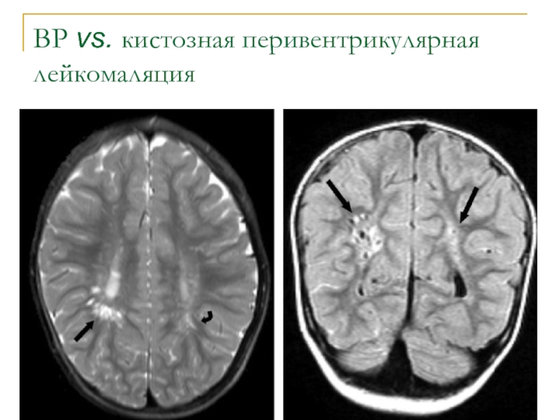 Мр изменения. Пространства Вирхова-Робина. Кистозная перивентрикулярная лейкомаляция. Пространства Вирхова-Робина мрт. Перивентрикулярная лейкомаляция мрт.