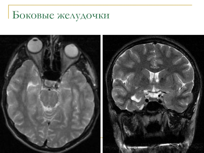 Расширение боковых желудочков мозга