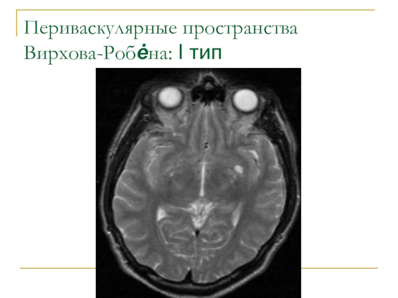 Периваскулярные пространства. Расширение периваскулярных пространств мрт. Периваскулярные пространства Вирхова-Робина расширены мрт. Расширение пространства Вирхова Робина на мрт. Киста пространства Вирхова-Робина.