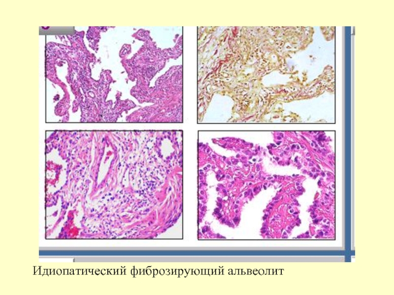 Макроскопическая картина легкого при фиброзирующих альвеолитах