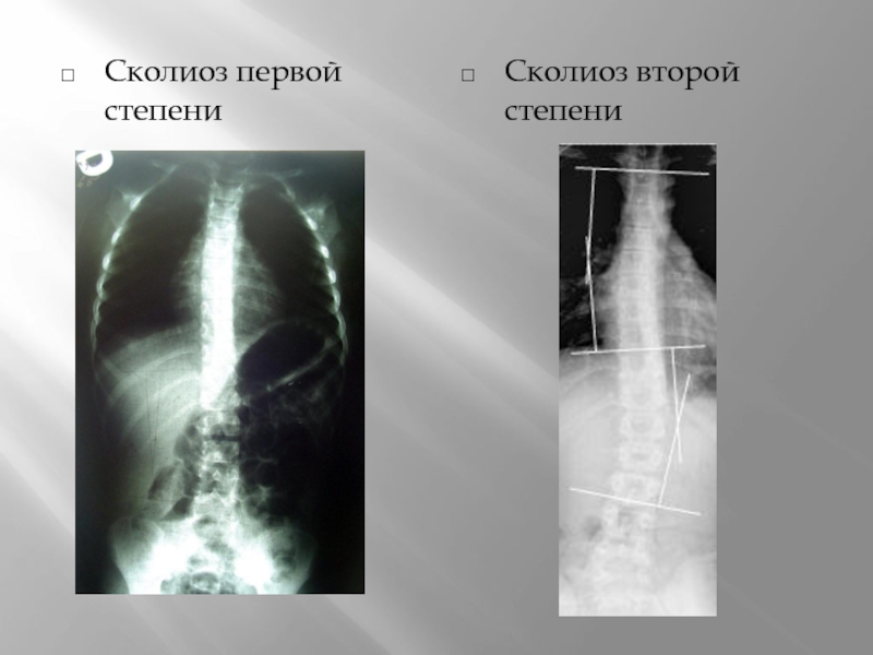 Сколиоз 2 степени. Сколиоз 1 степени рентген. Снимки сколиоза 1 степени. Сколиоз 1 степени и 2 степени.