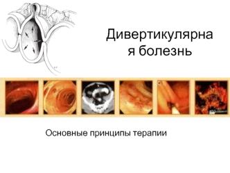 Дивертикулярная болезнь