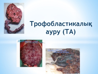 Трофобластикалық ауру