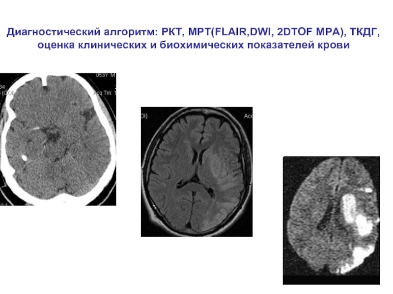 Очаги хронической ишемии головного