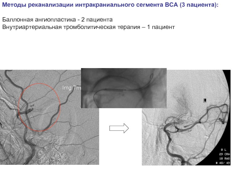 Интракраниальный отдел внутренней сонной артерии