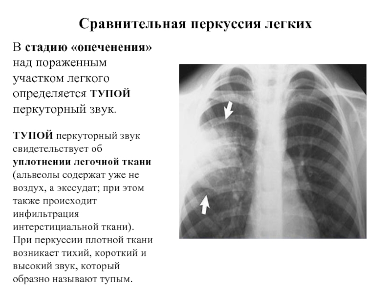 Участки легкого. Инфильтрация легочной ткани перкуторный звук. Звук при уплотнении легочной ткани. Перкуторно над легкими определяется легочный звук. При уплотнении легочной ткани перкуторный звук.