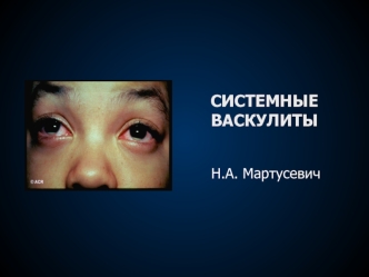 Системные васкулиты
