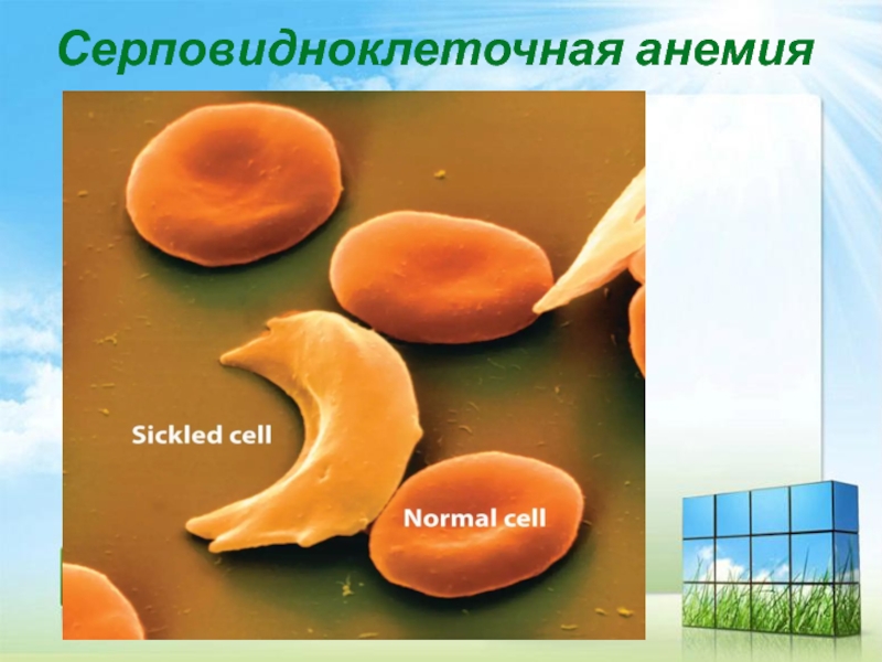 Серповидноклеточная анемия рецессивный. Серповидноклеточная анемия. Серповидноклеточная анемия желтуха. Серповидноклеточная анемия биохимия. Серповидноклеточная анемия регуляция.