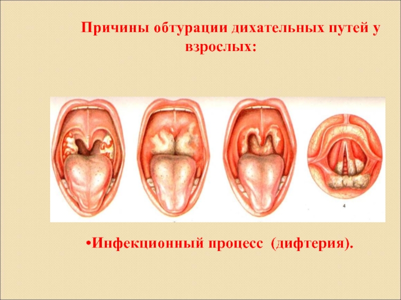 Дифтерия у детей картинки