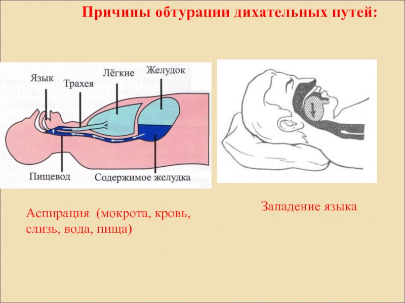 На рисунке 69 показано что происходит при западении языка