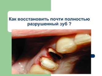 Как восстановить почти полностью разрушенный зуб ?