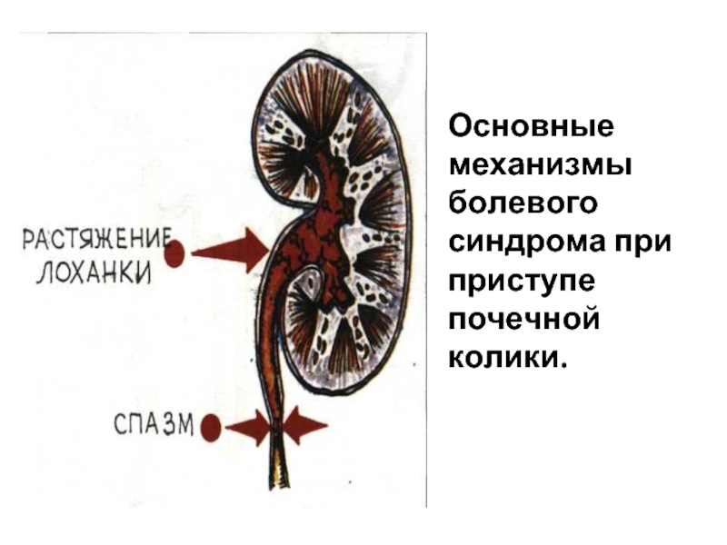 Живот при почечной колике