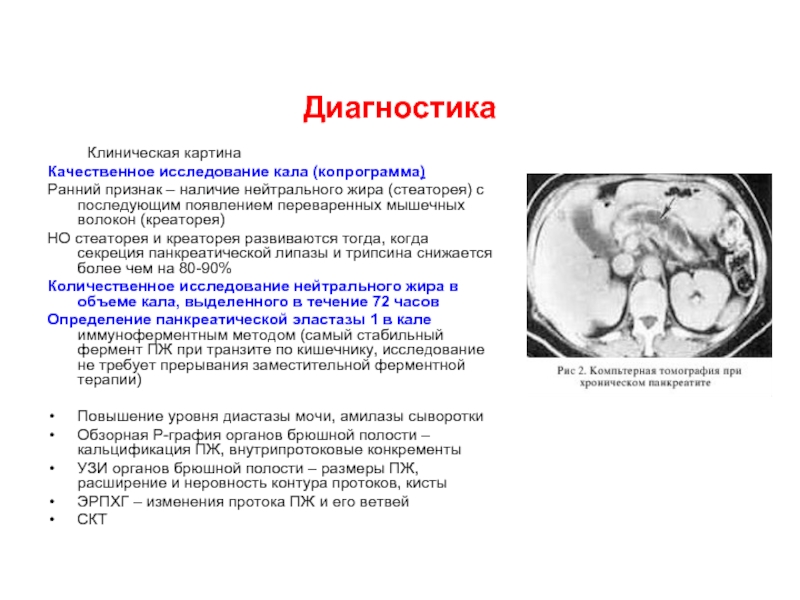 Клиническая картина диагностика. Хронический панкреатит копрограмма. Уровень липазы при хроническом панкреатите. Хронический панкреатит диастаза. Амилаза панкреатическая при хроническом панкреатите.