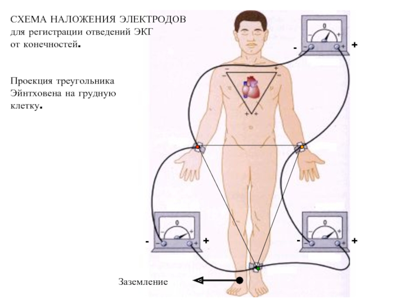 Экг наложение электродов фото. Заземление ЭКГ. Наложение электродов при регистрации ЭКГ. Электроды ЭКГ наложение на конечности. Наложение электродов ЭКГ У женщин.