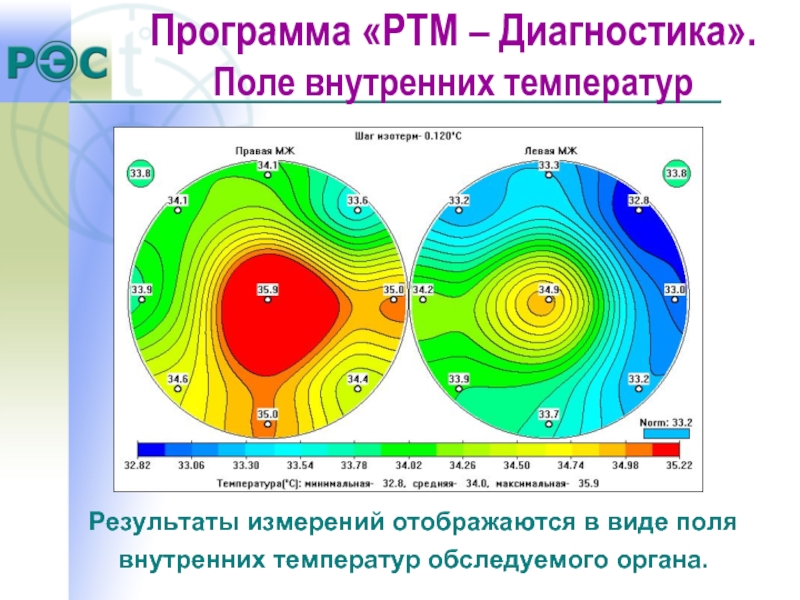 Температурное поле. Радиотермометрия. Температурное поле примеры. Радиотермометрия молочных желез.