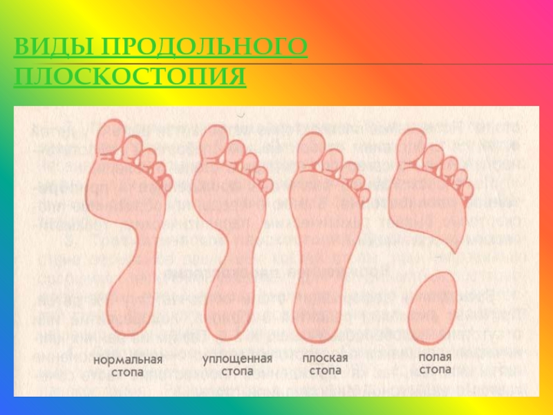 Полой стопы. Плоская стопа уплощенная стопа. Полая стопа и нормальная стопа. Стопа нормальная уплощенная плоская. Полая форма стопы.