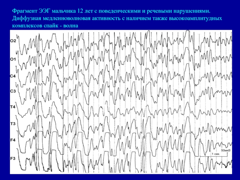 Амплитуда пароксизмальной активности. Эпилептиформная активность на ЭЭГ. Высокоамплитудные Дельта волны на ЭЭГ. ЭЭГ волны патологические. Эпилептиформный очаг на ЭЭГ.