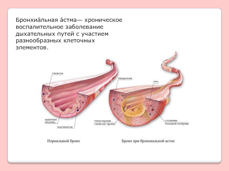 Бронхиальная астма хроническое воспаление. Хронического воспаления клеточные элементы.