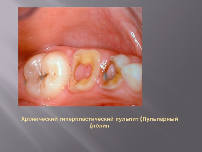 Хронический пульпит презентация