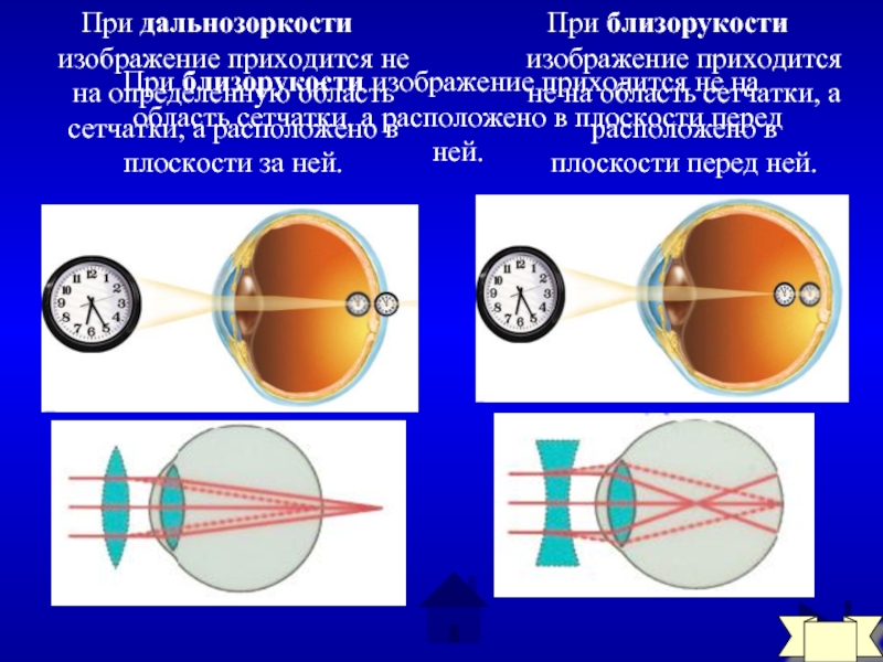 Глазное яблоко удлиненной формы четкое изображение