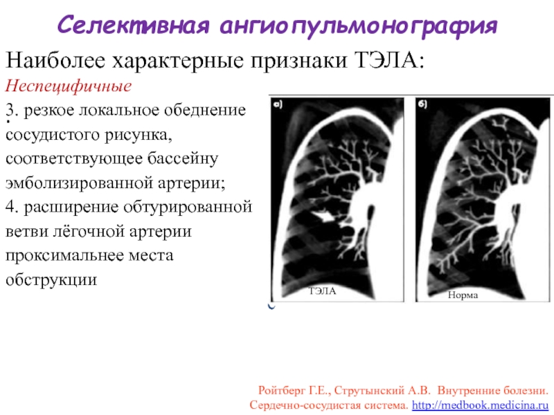 Обеднение сосудистого рисунка легких характерно для