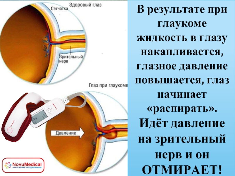 Глазное давление боль. Внутриглазное давление глаза. Давление на сетчатку глаза. Глаукома норма внутриглазного давления.