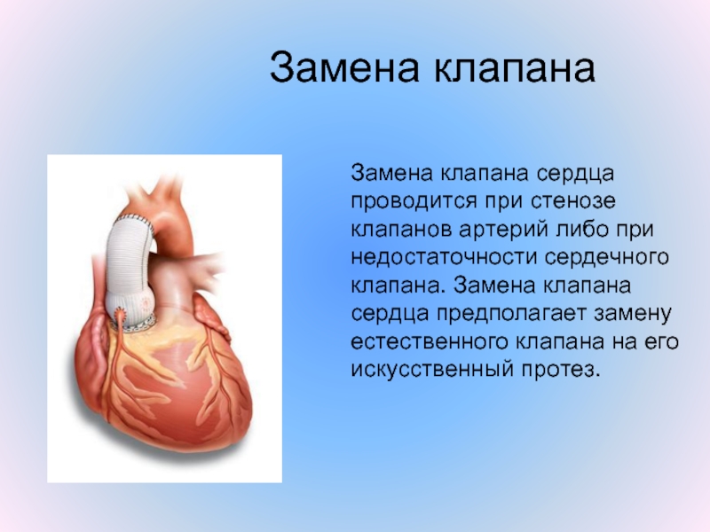 Как клапан делает операция. Операция на клапан сердца. Поменять клапан на сердце. Клапана на сердце человека искусственные.