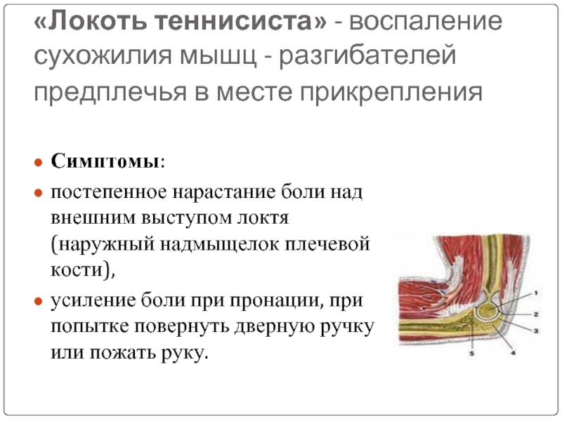 Болезнь теннисиста в локтевом суставе. Сухожилие разгибателей локтевого сустава болит. Тендинит сухожилия локтевой разгибатель. Сухожилие мышц разгибателей болит. Воспаление сухожилий предплечья.