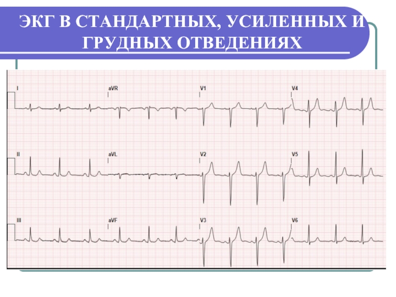 Экг стандартная. Второе стандартное отведение ЭКГ. Третье стандартное отведение ЭКГ. ЭКГ во 2 стандартном отведении. 3 Стандартное отведение ЭКГ норма.