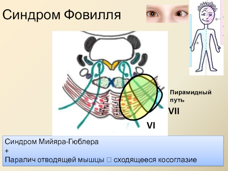 Синдром мийяра гюблера. Синдром Мийяра Гублера. Альтернирующие синдром Маяре. Альтернирующий синдром Мийяра-Гюблера. Синдром Мийяра Гюблера неврология.