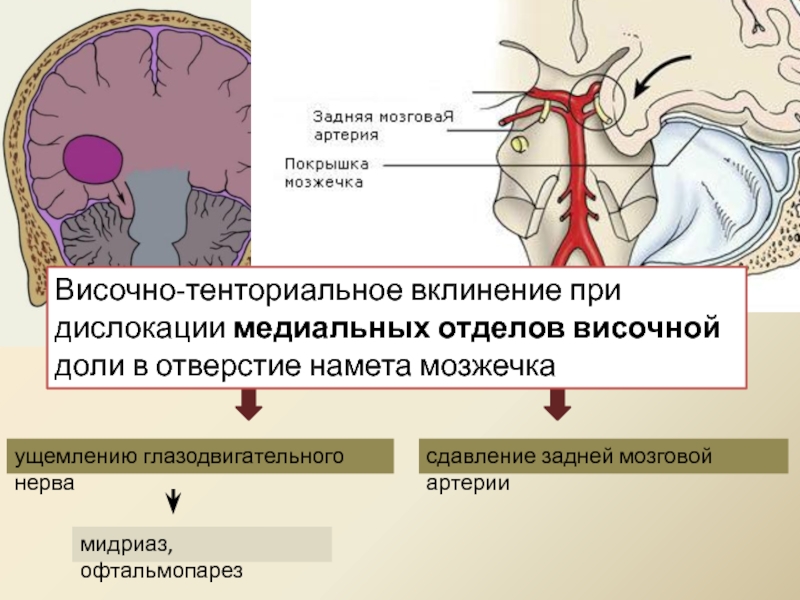 Функция заднего головного мозга. Височно-тенториальное вклинение. Височно-тенториальная дислокация. Сдавление глазодвигательного нерва. Вклинение височной доли.