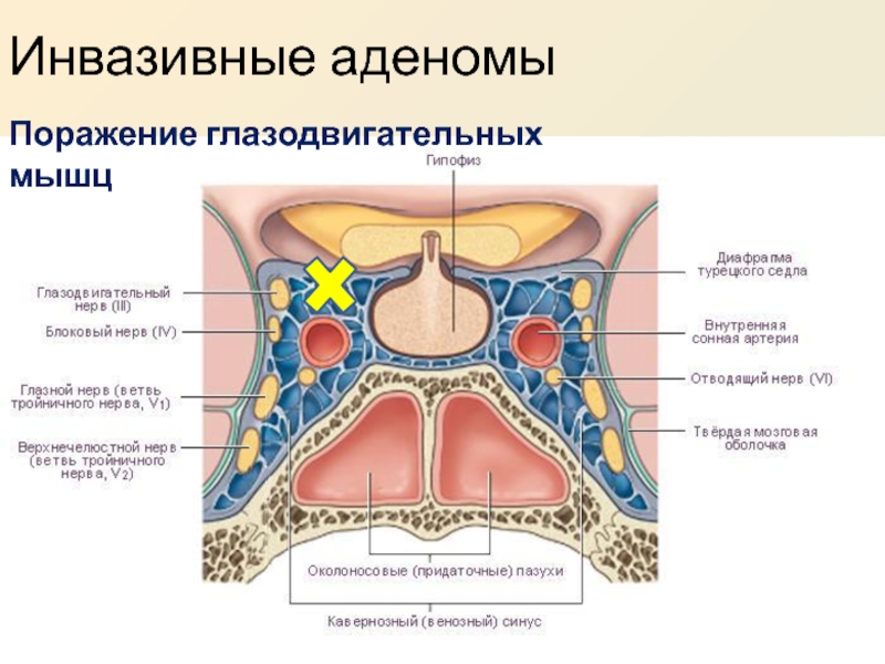 Тромбоз кавернозного синуса фото