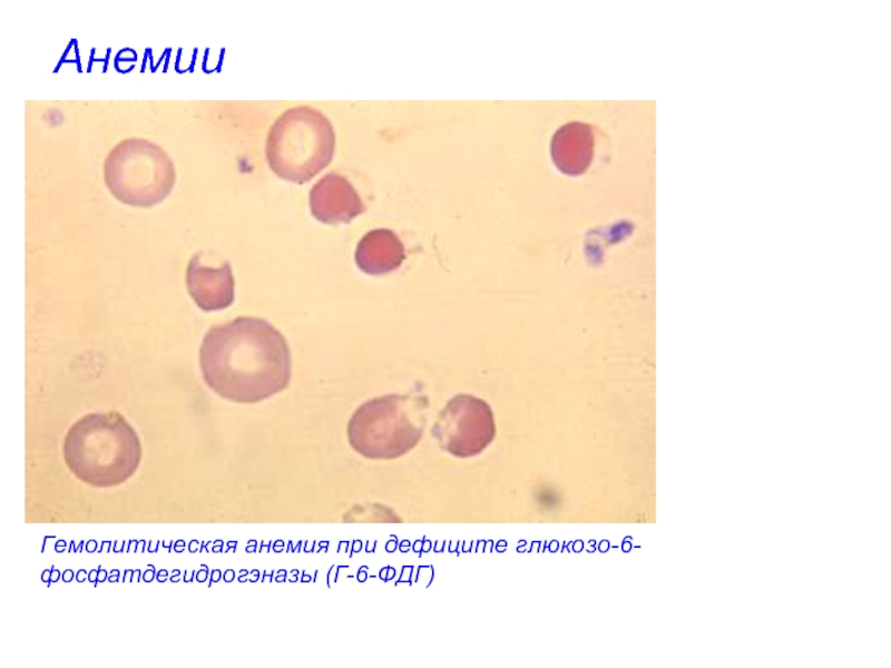 Картина крови при гемолитических анемиях