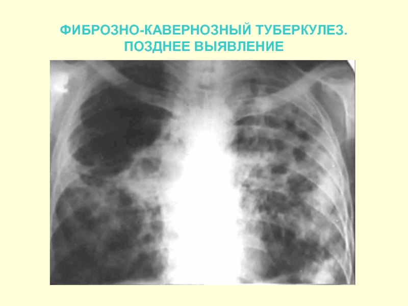Исходы туберкулеза легких