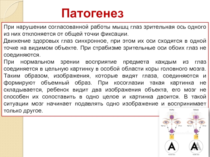 При нормальном зрении изображение проецируется где