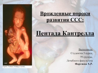 Врожденные пороки развития ССС: Пентада Кантрелла