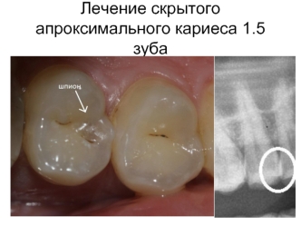 Лечение скрытого апроксимального кариеса зуба