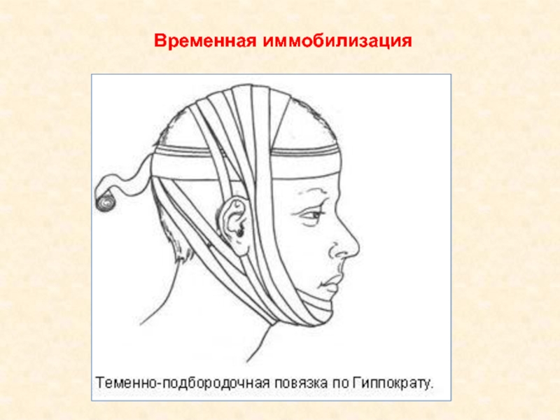 Методы временной и постоянной иммобилизации отломков челюстей презентация