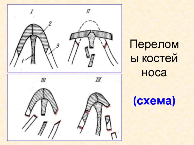 Закрытый перелом носа карта вызова