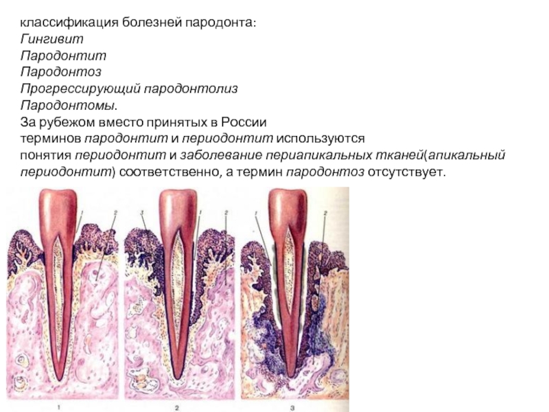 Периодонтит определение этиология классификация стадии макроскопическая картина осложнения и исходы
