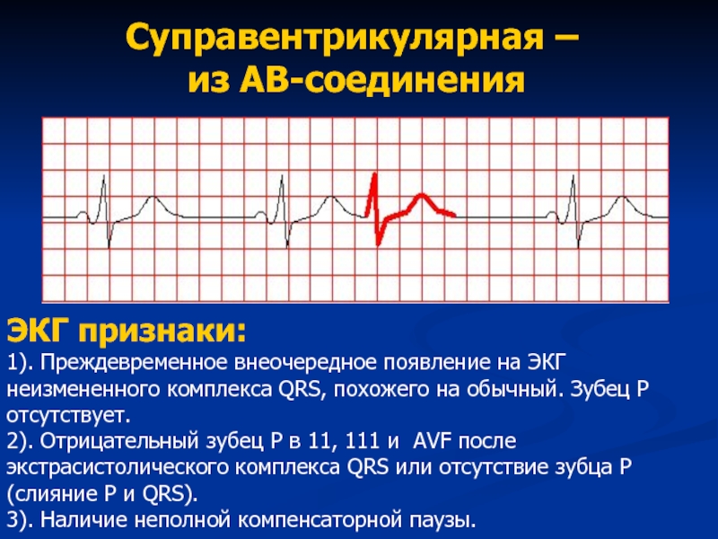 Экг отрицательный. Внеочередной комплекс QRS на ЭКГ. Отрицательный зубец р после QRS комплекса. Отсутствие комплекса QRS на ЭКГ. Отрицательный р на ЭКГ.