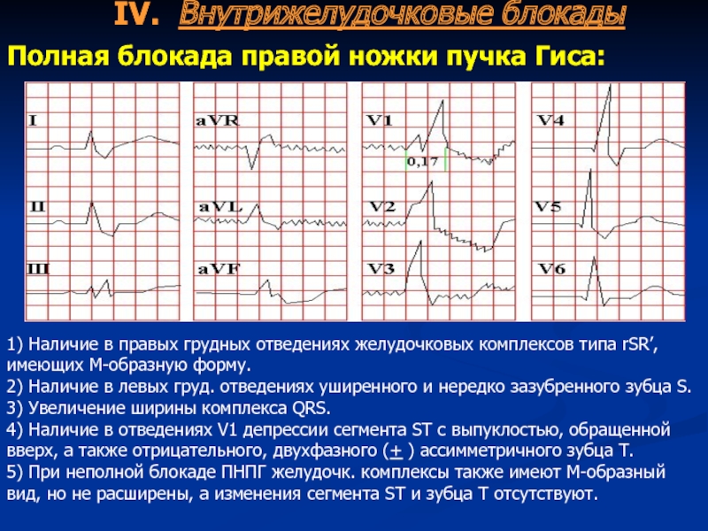 Полная блокада левой. Критерии блокады правой ножки пучка Гиса. QRS при полной блокаде правой ножки пучка Гиса. Блокада передней ветви правой ножки пучка Гиса на ЭКГ. Блокада правой ножки пучка Гиса классификация.