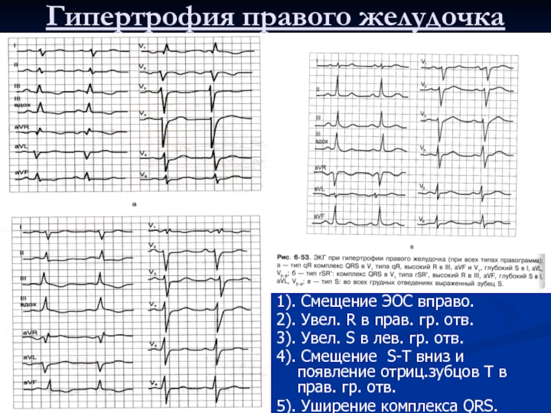 Эос отклонена вправо. ЭКГ при отклонении ЭОС вправо. Гипертрофия правого желудочка смещение. ЭОС вправо на ЭКГ S Тип гипертрофии правого желудочка. Причины отклонения электрической оси сердца вправо.