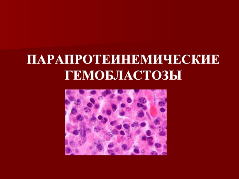 Гемобластозы это. Парапротеинемические гемобластозы (миеломная болезнь). При парапротеинемических гемобластозах. Парапротеинемические гемобластозы основные формы. Парапротеинемические гемобластозы клинические рекомендации.