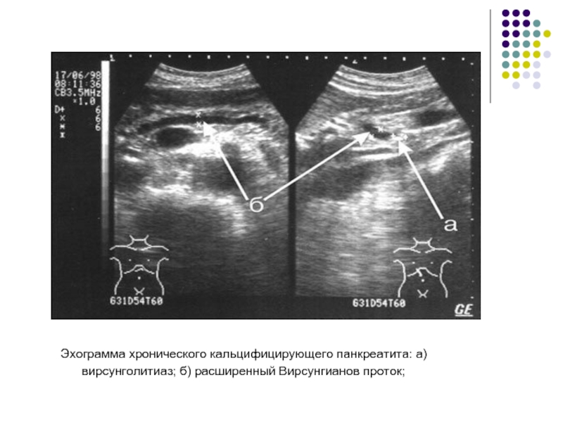 Узи картина хронического панкреатита