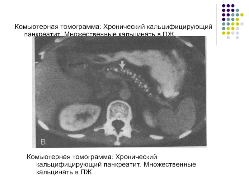 Созылмалы панкреатит презентация