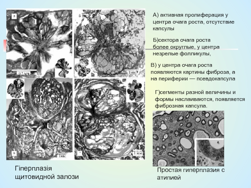 Фиброза капсулы. Пролиферация растений.